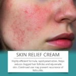 Folliculitis Relief Cream Cih Bmqsb49r 4